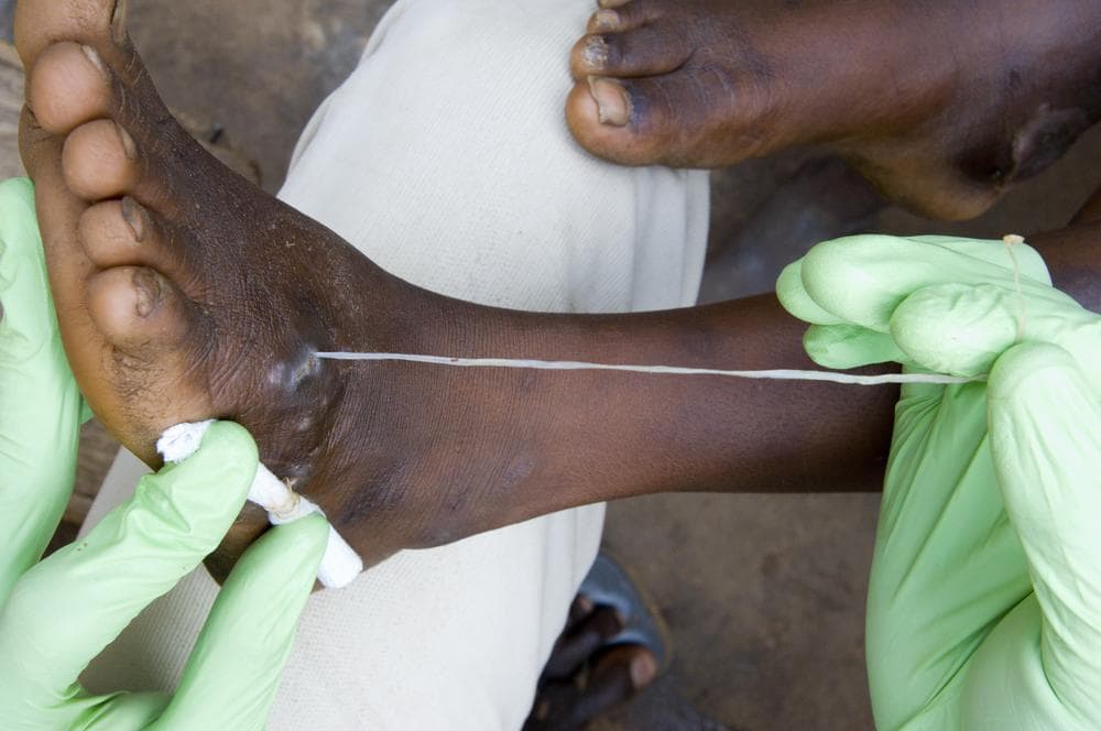 Eradicating Guinea Worm Here & Now