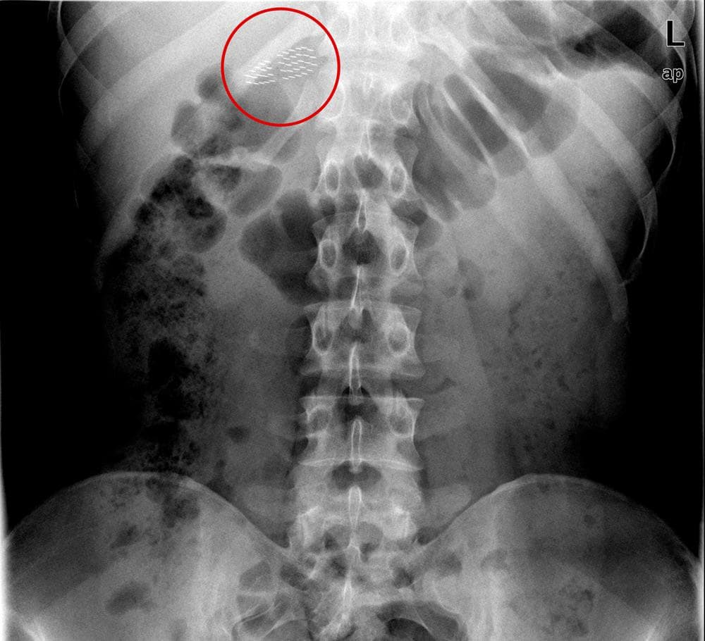 The Mystery Of The Patients Who Swallowed Their Toothbrushes WBUR News