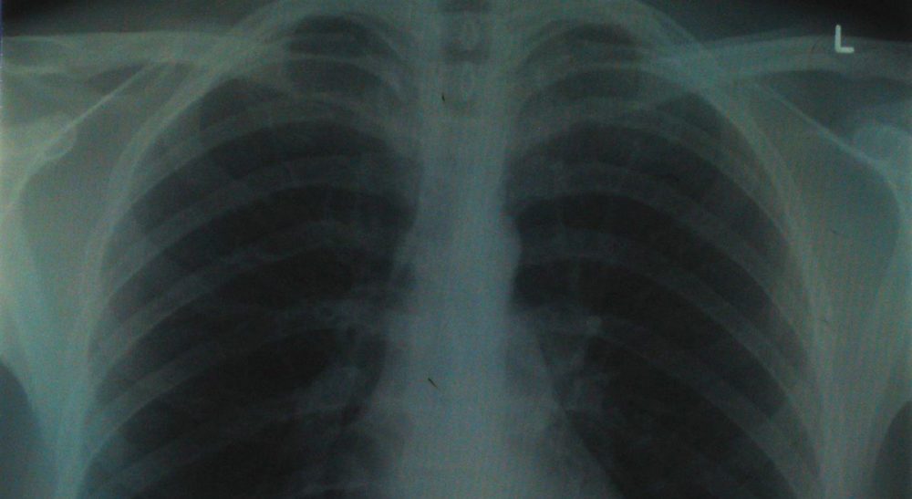 healthy lungs vs smokers lungs x ray