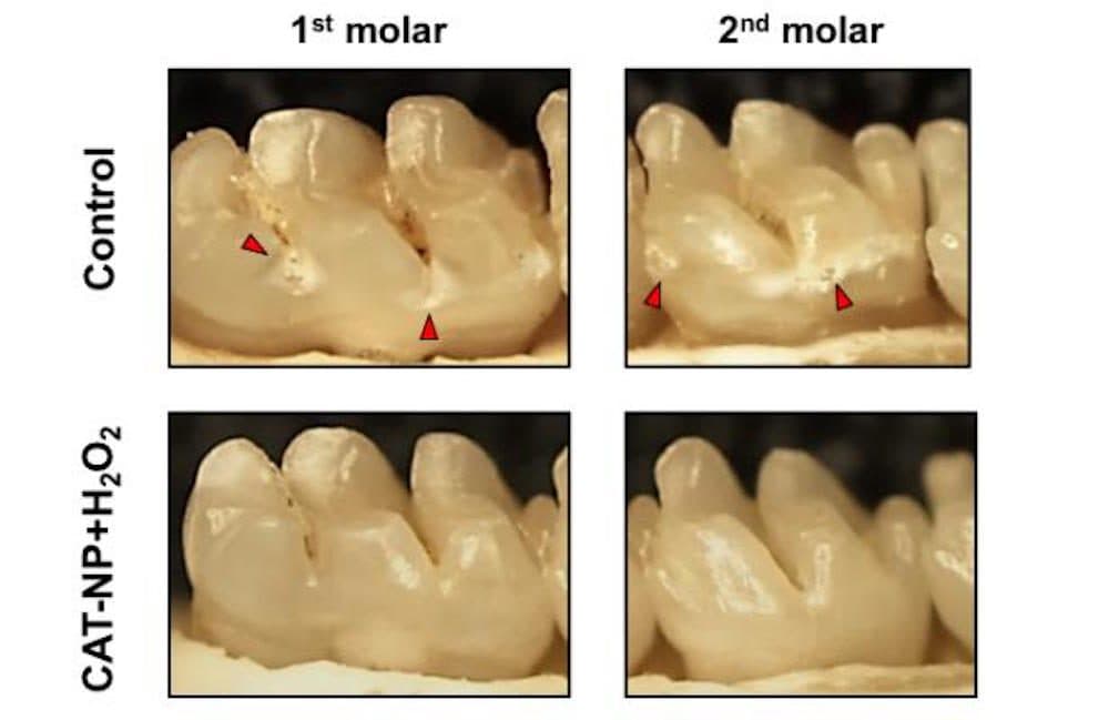 toothpaste to remove cavity