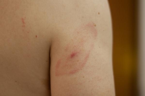 The classic "bullseye rash" of Lyme Disease