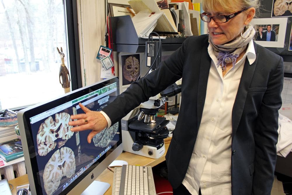 Dr. Ann McKee, co-founder of Boston University's Center for the Study of Traumatic Encephalopathy, points to images of brains with signs of the degenerative brain disease. (Lisa Tobin/WBUR)