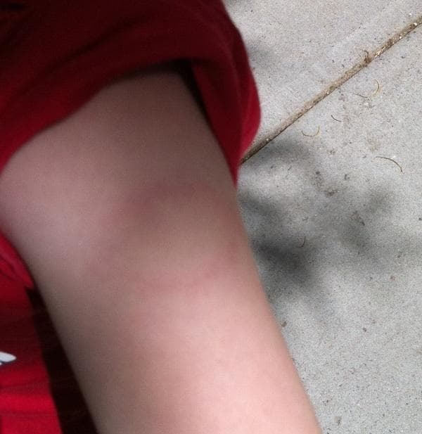 A classic Lyme Disease "bullseye" on my son's arm