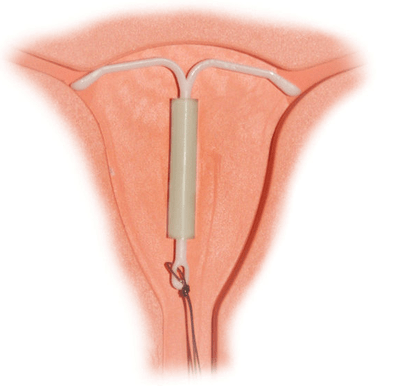 Why The IUD Is On The Rise (And You Might Want One)