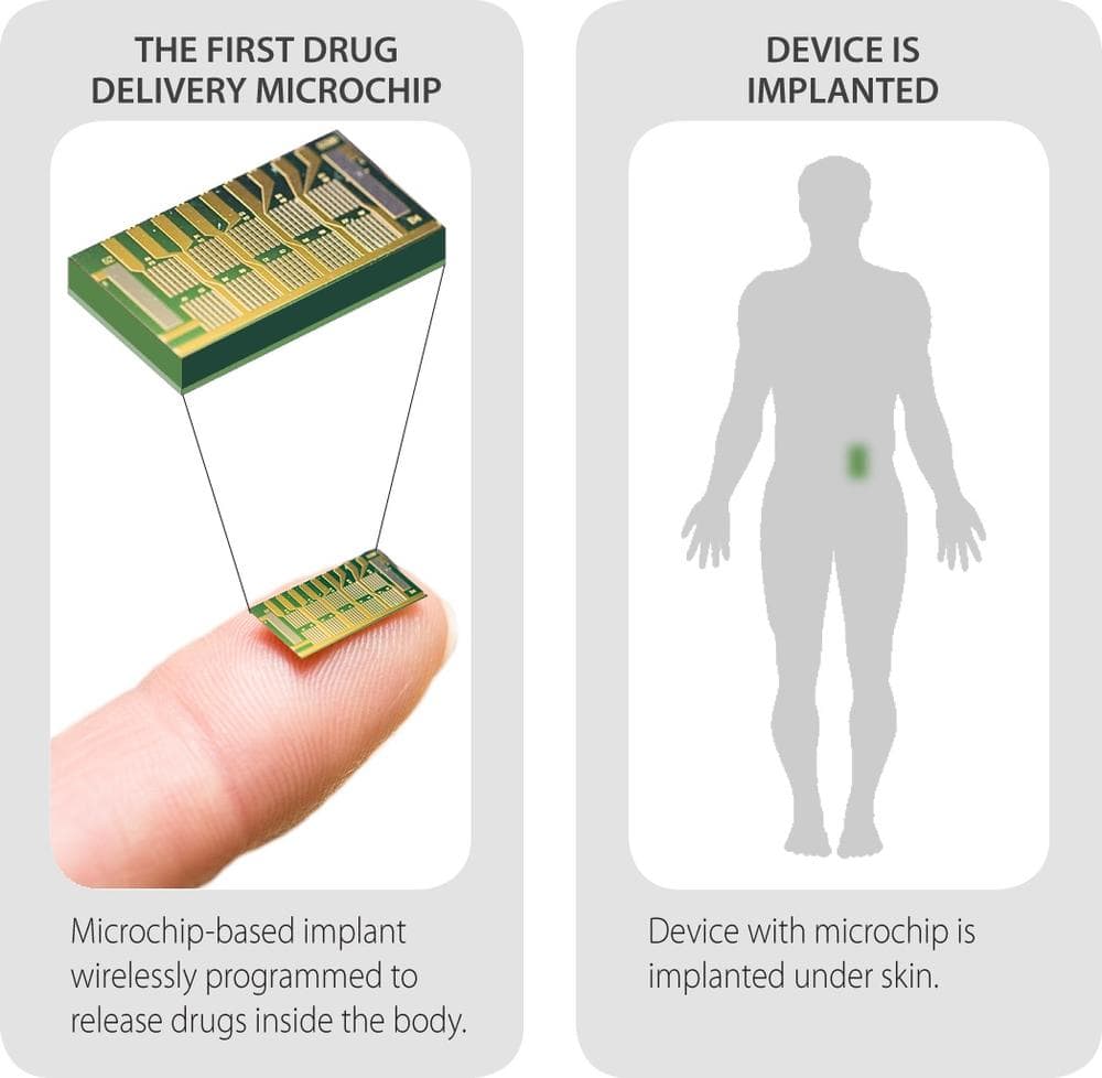 An image of the new microchip and where it would be implanted