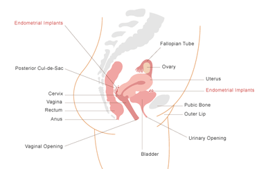 Endometriosis occurs when cells that normally grow in the lining of the uterus start growing in other parts of the body. (Illustration courtesy of Children's Hospital Boston)