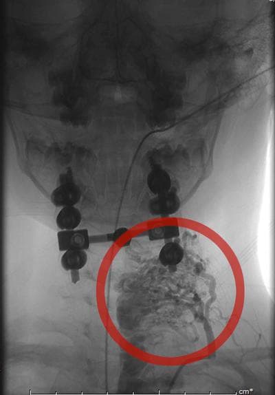 The angiogram of the “arteriovenous” malformation (AVM) in Riley's spine. (Courtesy of Kristen Davis)