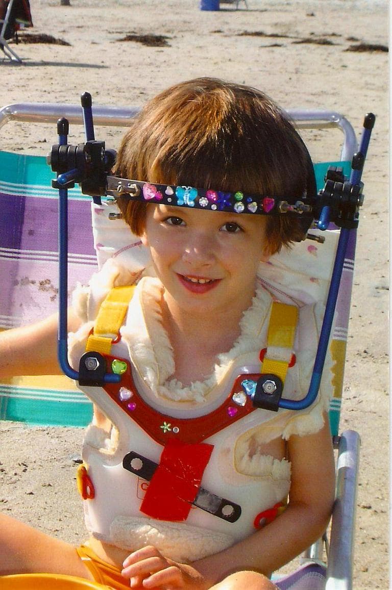 Riley wearing the "Halo" after the spinal fusion surgery in 2006. (Courtesy: Kristen Davis)