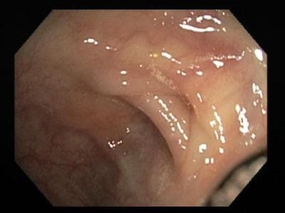 Gateway to the author's colon (Courtesy)