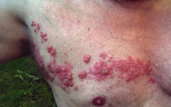 Shingles (Wikimedia Commons)