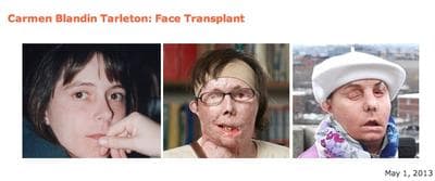 Photos from Brigham & Women's Hospital of its latest face transplant recipient, Carmen Blandin Tarleton. (Courtesy BWH)