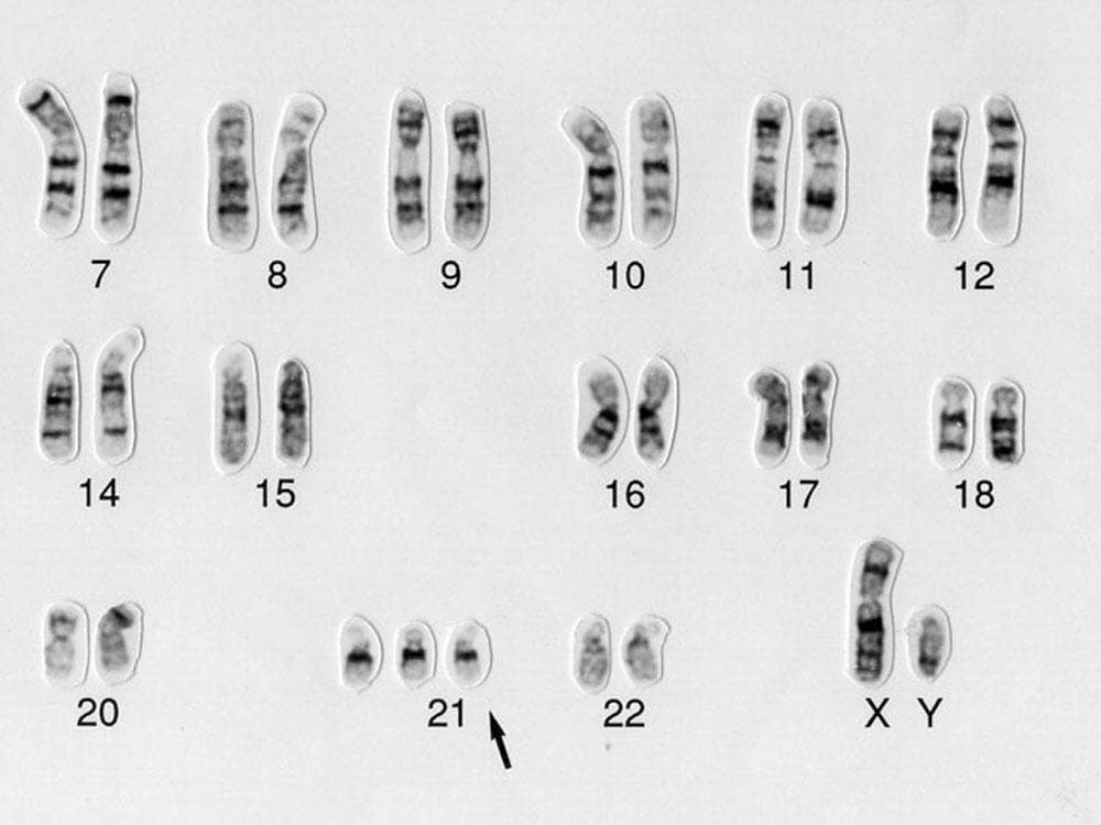 Набор дауна. Синдром Дауна (трисомия по 21 паре хромосом). Синдром Дауна трисомия 21 хромосомы. Синдром Дауна кариотип.