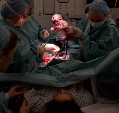 The moment of birth during a Cesarean section (Wikimedia Commons)