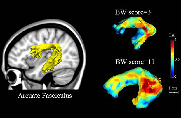 Implicated in dyslexia: The arcuate fasciculus is an arch-shaped bundle of fibers that connects the frontal language areas of the brain to the areas in the temporal lobe that are important for language (left). Researchers found that kindergarten children with strong pre-reading scores have a bigger, more robust and well-organized arcuate fasciculus (bottom right) while children with very low scores have a small and not particularly well-organized arcuate fasciculus (top right). (Zeynep Saygin/MIT)