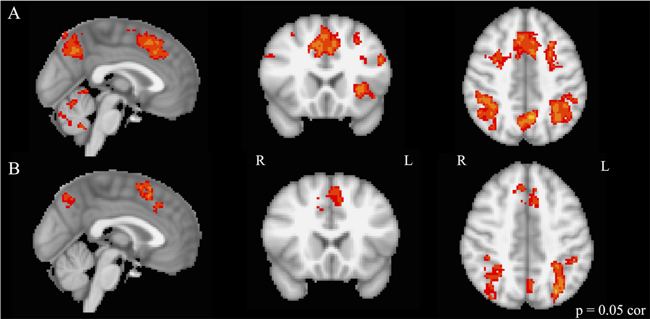 MRI scans show brain activation during executive functioning testing. The top row, row A, is of musically trained children. The bottom row, row B, is of untrained children. There's more activation in the musically trained children. (Courtesy Nadine Gaab)