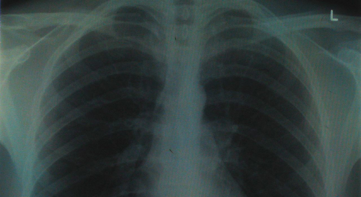 Dr. Lecia V. Sequist: "Because one of the strongest risk factors for lung cancer is smoking, our society has come to the conclusion that people diagnosed with lung cancer somehow deserve it, that it was brought on by their own ‘bad’ behavior." Pictured: A healthy set of lungs. (aidan_jones/Flickr)