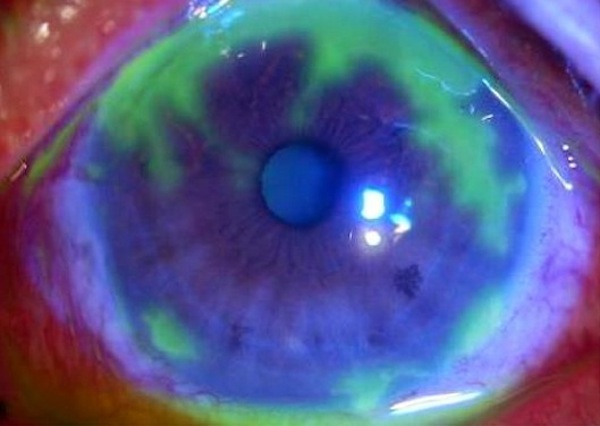 Fluorescent staining shows areas of the cornea affected by herpes virus that infected a man's eyes. (Photo: Wikipedia)