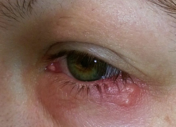 Herpes viruses are best known for causing cold sores and genital lesions but they can also affect the eye, potentially leading to blindness. (Photo: Wikimedia Commons)