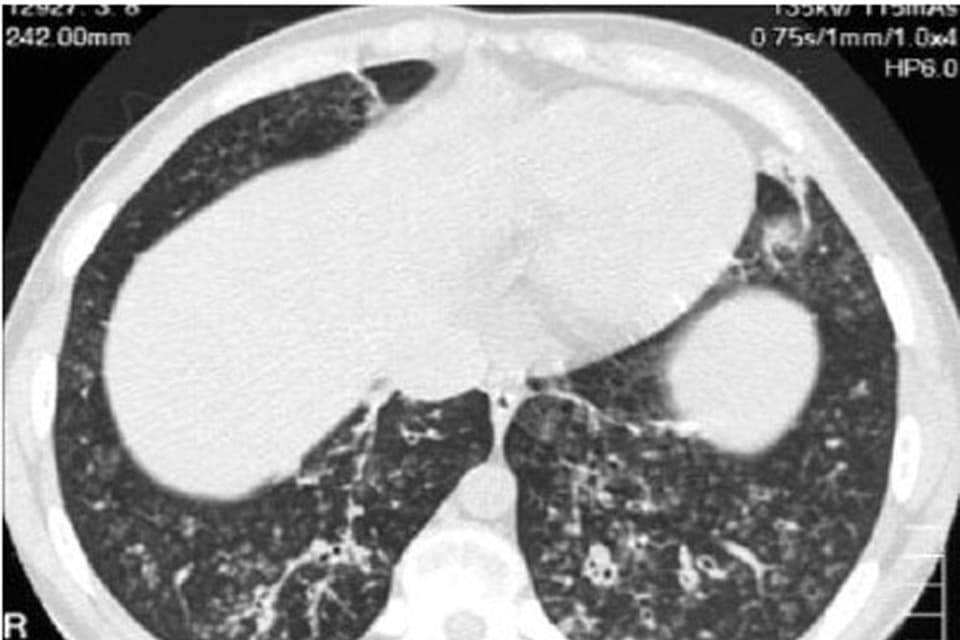 Cystic fibrosis, shown here in a high resolution computed tomographic image, is one of the many conditions that personalized medicine advocates say could be revolutionized by the individually tailored treatment. (M-P Anthony, S Singham, B Soans, G Tyler / WikiCommons)