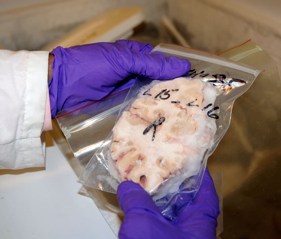 Tissue from one of the 800 brains scientists at Columbia University have collected from those who died by suicide and other causes. Postmortem brain studies have helped researchers pinpoint abnormalities in specific locations of the brain in those who killed themselves. (Lynn Jolicoeur/WBUR)