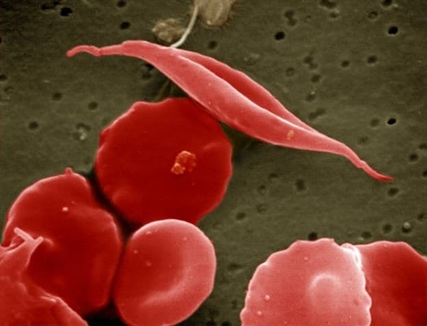 A "sickled" cell is seen among normal red blood cells. (Wikimedia Commons)