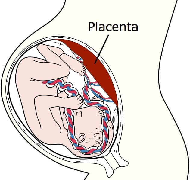 Placenta Accreta Pregnancy Complication - Brigham and Women's Hospital