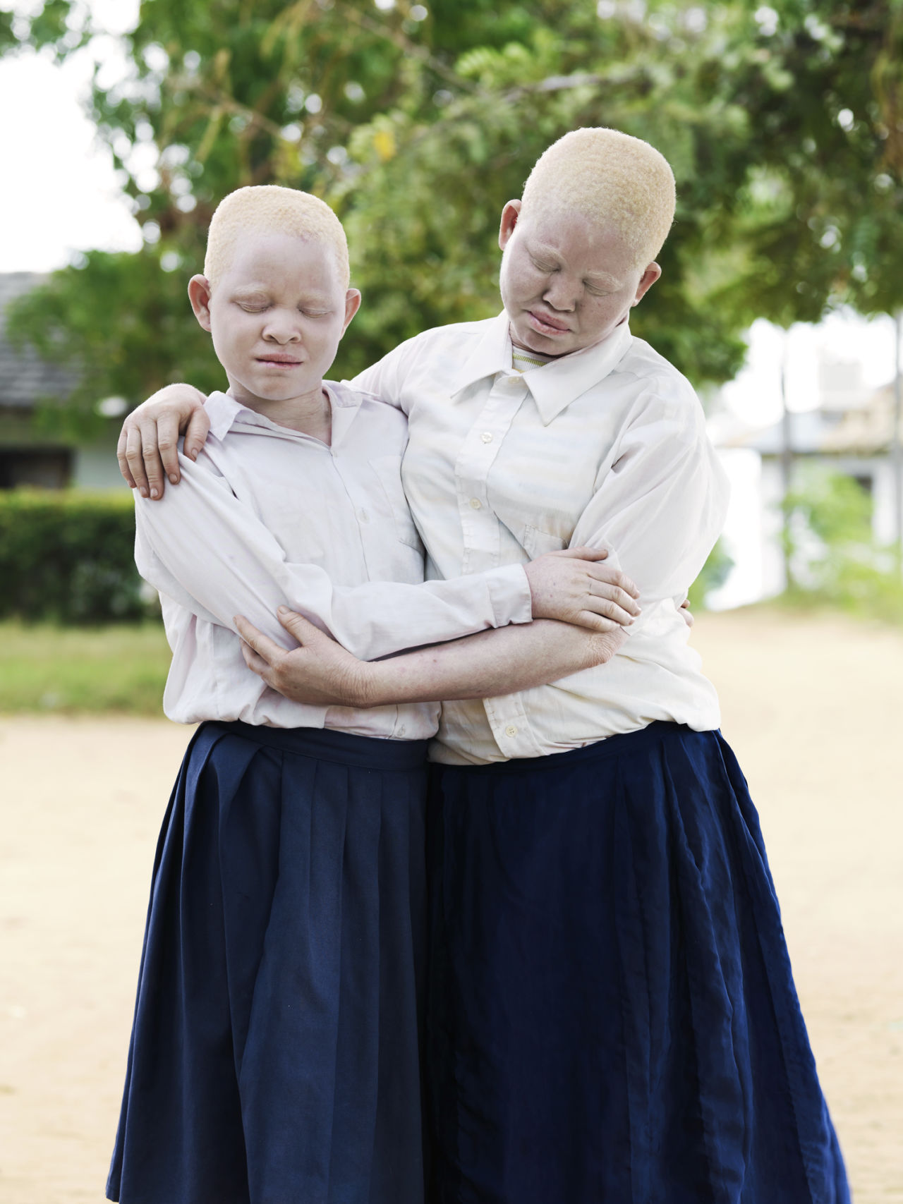 Как люди рождаются альбиносами. Европеоид альбинос.
