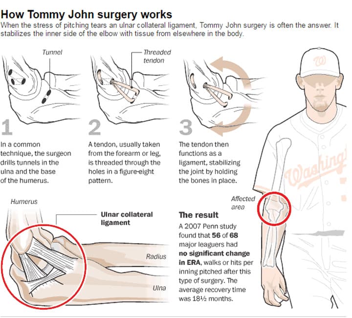 A diagram of how Tommy John surgery works. (Via Baseball Prospectus, American Journal of Sports Medicine | Bonnie Berkowitz and Alberto Cuadra/The Washington Post - August 28, 2010)