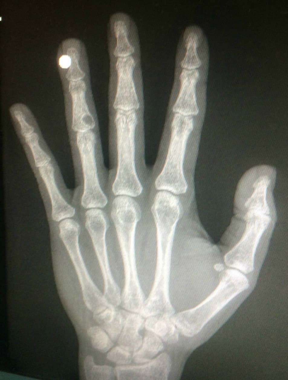An X-ray of the author's hand after her magnet was implanted (Alex Pearlman)