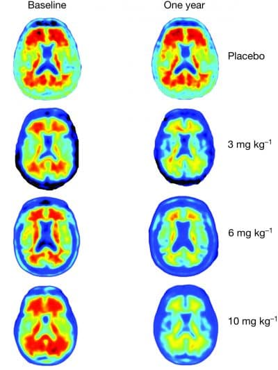 These images show that the more of the drug aducanumab patients received, the less amyloid they had in their brains a year later. (Courtesy Sevigny et al; Nature)