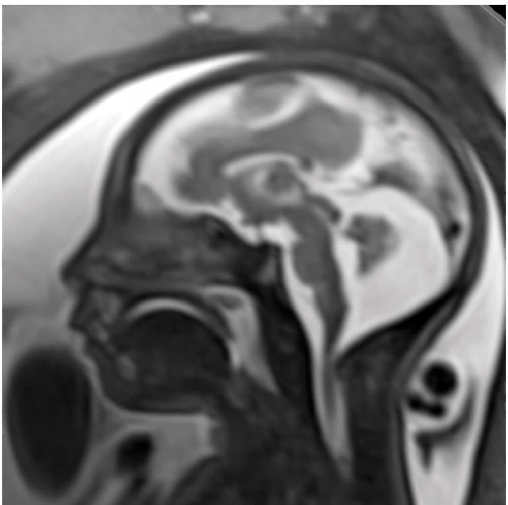 Image obtained at 29 weeks in the case of a 34-year-old woman with confirmed Zika virus infection, initially seen for a rash at 8 weeks of gestation. Sagittal fetal MR images show atrophic frontal lobes, wide sylvian fissures, enlarged posterior fossa, abnormal gyral pattern, prominent cerebrospinal fluid spaces, and inferior vermian hypoplasia. The hypoplastic corpus callosum can be seen, as well as the inferior vermian hypoplasia, enlarged cisterna magna, and heterogeneous signal intensity in the confluence of sinuses. There is a subjectively thin spinal cord. (Courtesy of Radiology, Radiological Society of North America)