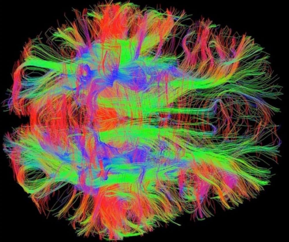 A map of nerve fibers in the human brain (. (Courtesy of Zeynep Saygin/Massachusetts Institute of Technology.)
A map of nerve fibers in the human brain (. (Courtesy of Zeynep Saygin/Massachusetts Institute of Technology.)