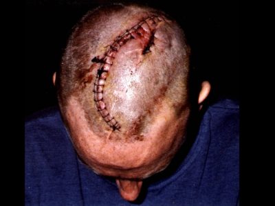Paul Pritchard's head after the accident. (Matthew Newton)