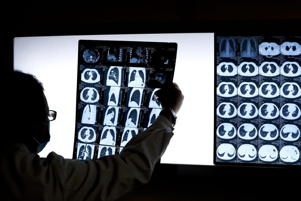 In this 2016 photo, a Chinese doctor Peng Limei looks at a CT scan of a lung cancer patient. (Andy Wong/AP)