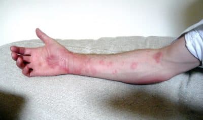 Acute urticaria, or hives (Courtesy of Andy Carter/Flickr)