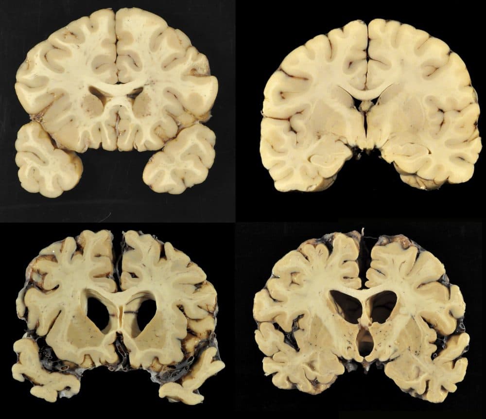 This combination of photos provided by Boston University shows sections from a normal brain, top, and from the brain of former University of Texas football player Greg Ploetz, bottom, in stage IV of chronic traumatic encephalopathy. According to a study released Tuesday, research on the brains of 202 former football players has confirmed what many feared in life: evidence of CTE, a devastating disease in nearly all the samples, from athletes in the NFL, college and even high school. (Dr. Ann McKee/BU via AP)