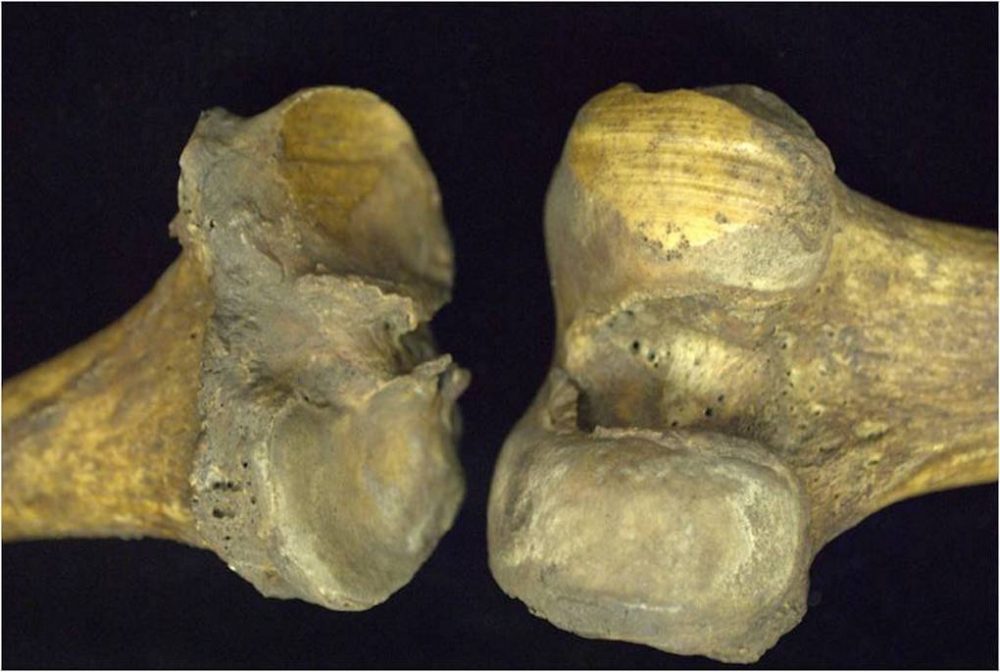 The polished area on these knee bones, called eburnation, on this 81-year-old woman's skeleton is a telltale sign of arthritis. (Courtesy Heli Maijanen)