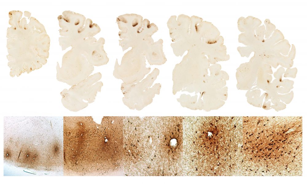 This graphic, BU researchers say, shows the classic features of CTE in the brain of Hernandez. (Courtesy BU CTE Center)