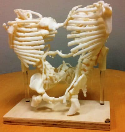 A surgical model, based on CT scan images and produced by 3D printing, showing the skeletal structures and arterial connections of conjoined twins separated at Mass General Hospital for Children (Courtesy of The New England Journal of Medicine)