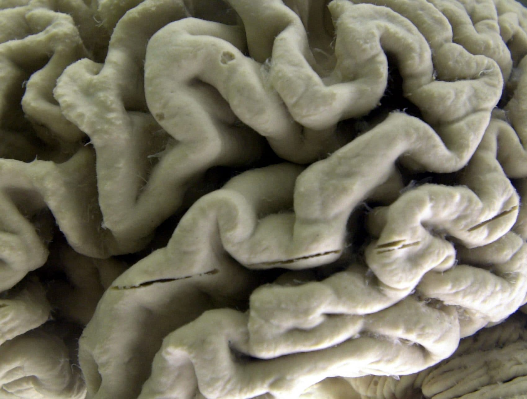 In this 2003 file photo, a section of a human brain with Alzheimer's disease is on display at the Museum of Neuroanatomy at the University at Buffalo. (David Duprey/AP)