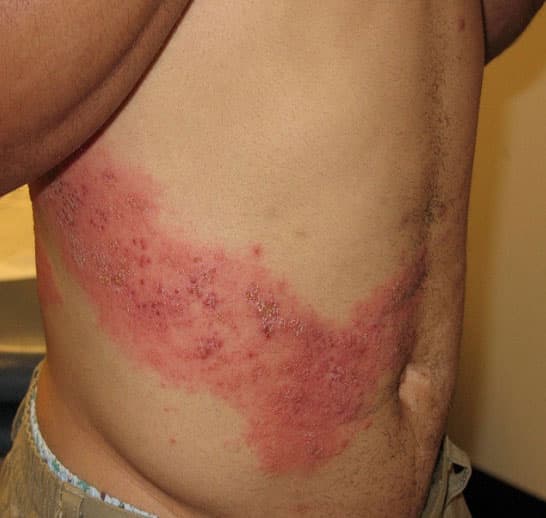 Shingles (Courtesy of NIAID via CDC)