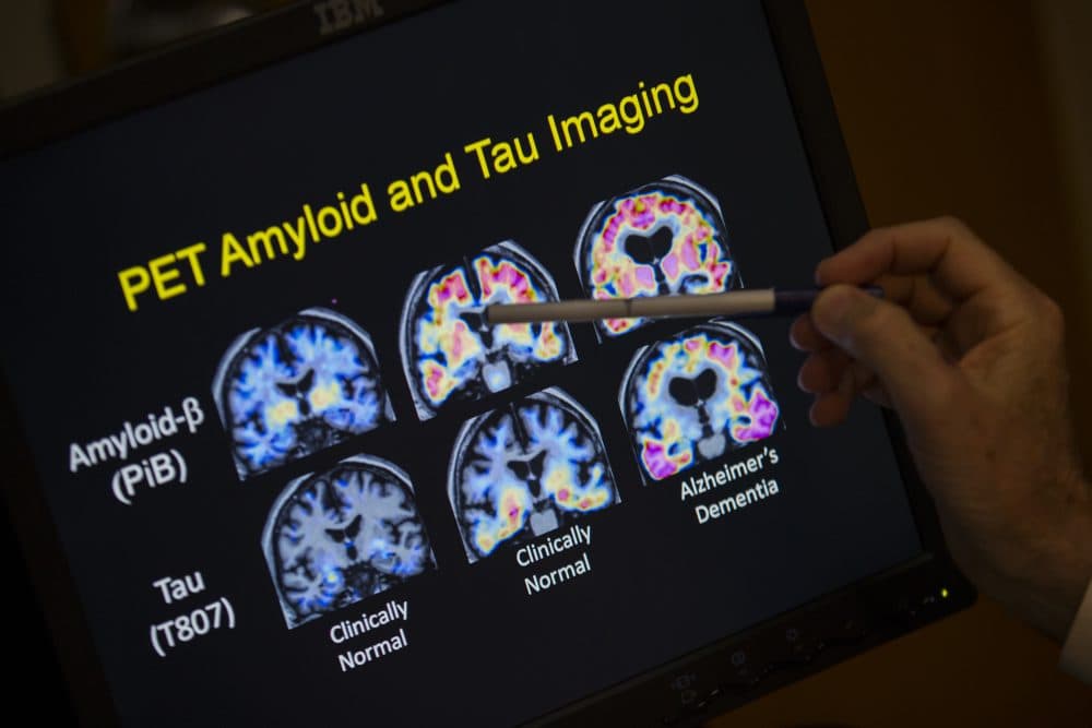 R. Scott Turner, professor of neurology and director of the Memory Disorder Center at Georgetown University Hospital, points to PET scan results that are part of a study on Allheimer's disease on May 19, 2015, in Washington. (Evan Vucci/AP)