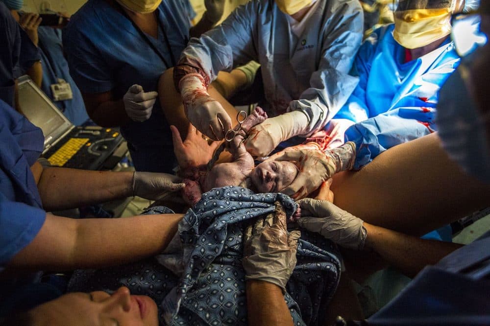 Bryce McDougall enters the world, cradled by the team of doctors and nurses, who turned him around and pulled him out to give parents Melisa and Shaun get what they wanted: a vaginal delivery. (Jesse Costa/WBUR)