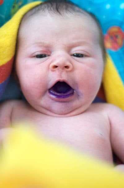 Baby Ashley, whose parents are fighting thrush with gentian violet (Courtesy Edwin and Kelly Tofslie/Flickr)