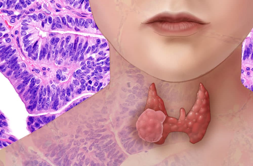 Thyroid cancer (National Human Genome Research Institute/Flickr)