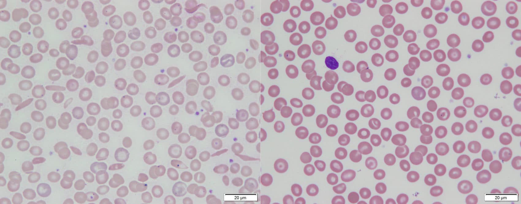 Manny Johnson's blood images. The left image shows how some of his red blood cells were &quot;sickled.&quot; On the right is a more recent picture, after his gene therapy. All his red blood cells look round and healthy.