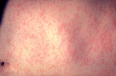 Rash on a patient’s abdomen three days after the onset of a measles infection (Dr. Heinz Eichenwald/CDC)