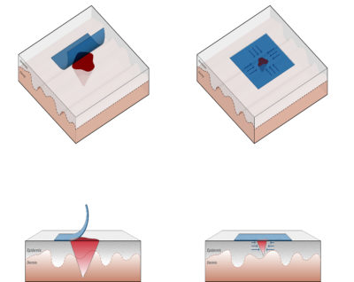 A visualization shows how the smart, jelly-like bandage shrinks in response to heat, allowing it to help close a wound. (Courtesy of Xin You, Jianyu Li)