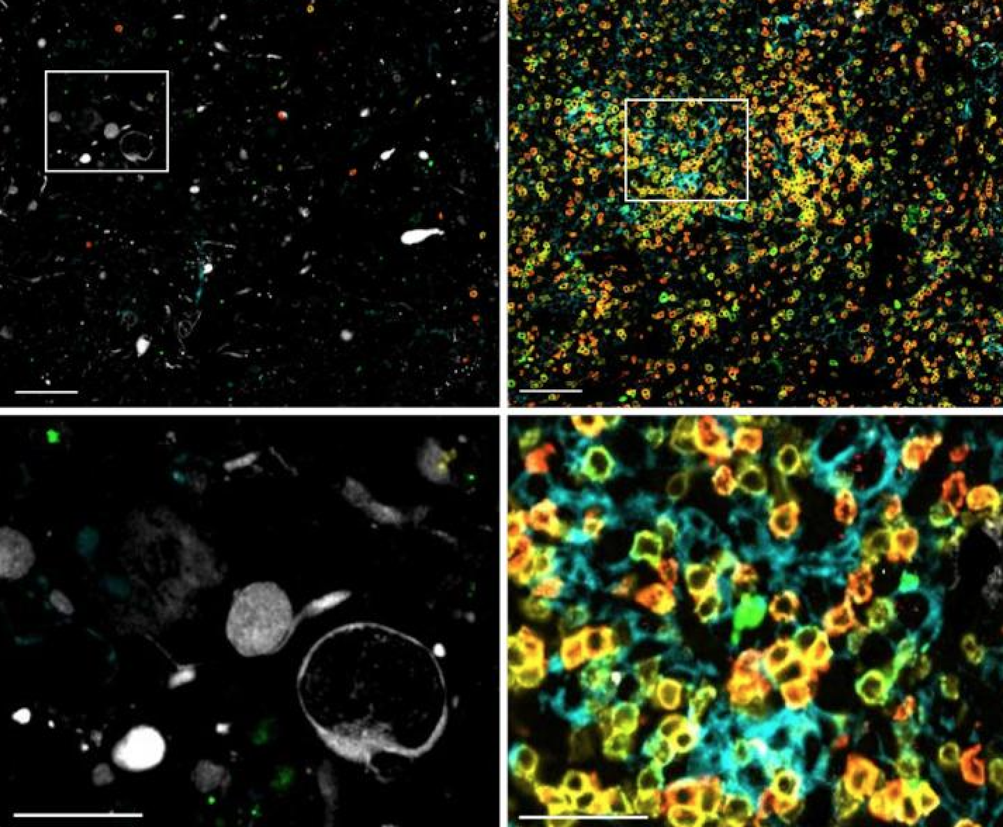 Glioblastoma from one treated patient at the time of surgical resection (left panels) and 175 days after treatment (right panels). There was a 17-fold increase in the number of tumor-infiltrating immune cells (yellow, green, cyan) after treatment. (E.A. Chiocca et al., Science Translational Medicine, 2019)