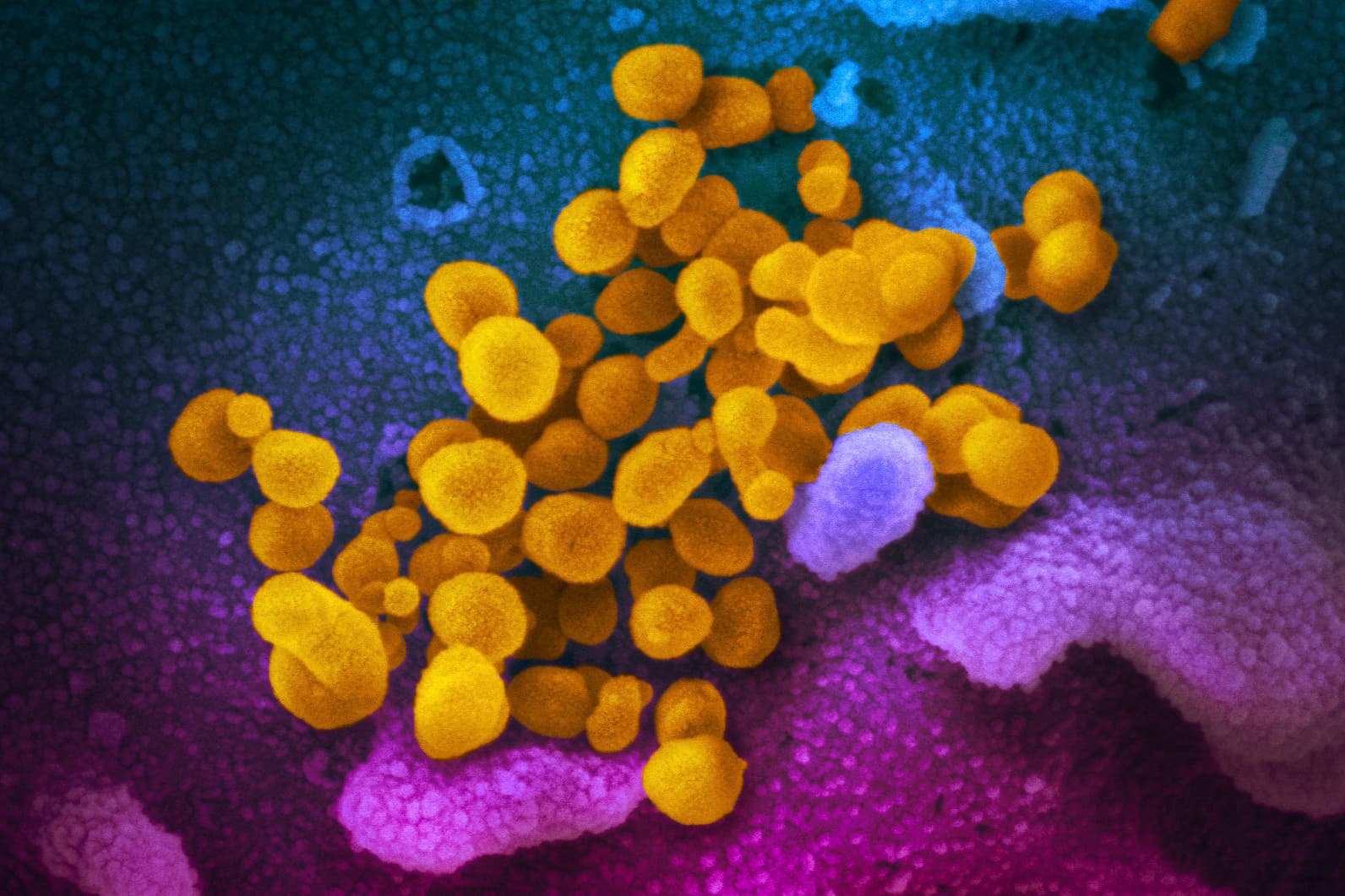 This undated electron microscope image made available by the U.S. National Institutes of Health in February 2020 shows the novel coronavirus. (NIAID-RML via AP)